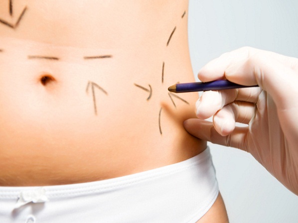 8 cirugías cosméticas que terminaron mal - La lipo de abdomen, nada sencilla
